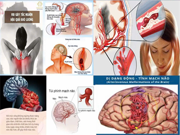 Trong hệ thống tuần hoàn, động mạch đóng vai trò quan trọng trong việc đưa máu giàu oxy đến các cơ quan và mô. Tuy nhiên, khi xuất hiện dịch nhầy nhiều dạng trong động mạch, quá trình lưu thông máu sẽ bị cản trở, gây nguy cơ cao cho các bệnh lý tim mạch. Việc hiểu rõ nguyên nhân, triệu chứng và cách xử lý sớm là vô cùng cần thiết để bảo vệ sức khỏe tim mạch.